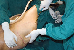 Bariatric surgery